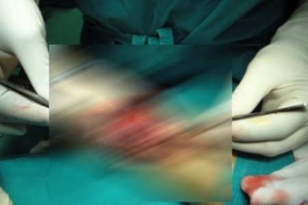 Δείτε τι έβγαλαν οι γιατροί στο «Παίδων» από το στομάχι μιας 8χρονης (βίντεο)